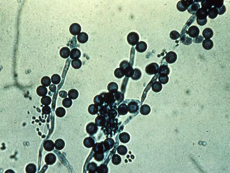 Candida Vajinal Mantar Görüntüsü