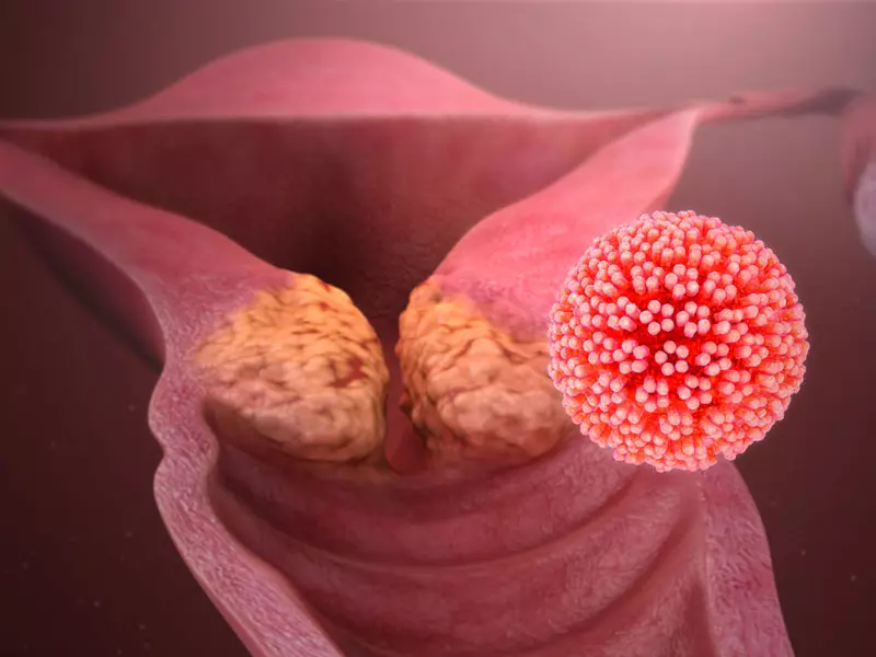 HPV Vücuttan Atılırmı?