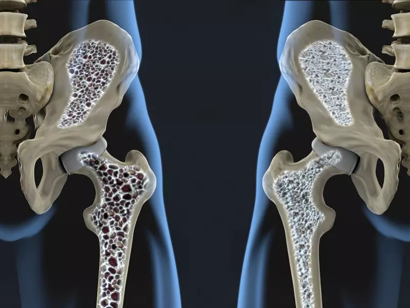 Osteopeniktir Ne Demek?