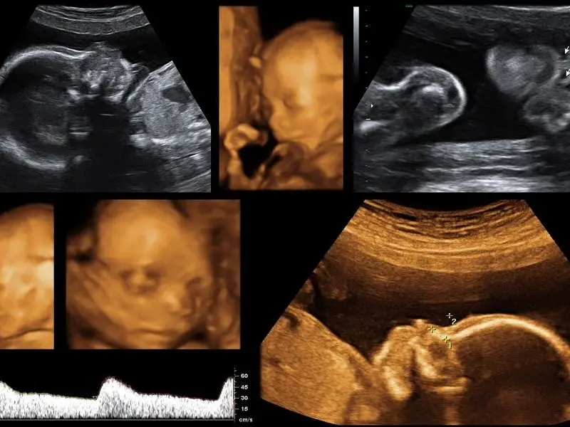 4D Ultrasound