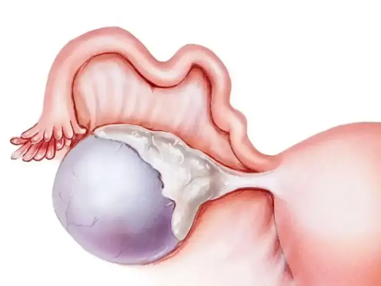 Bartholin Kisti