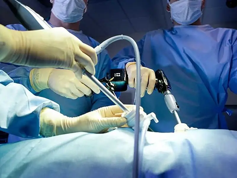 Closed Ovarian Cyst Surgery