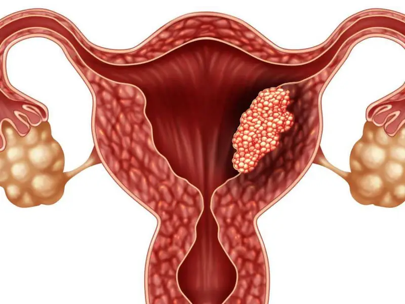 fibroid-surgery