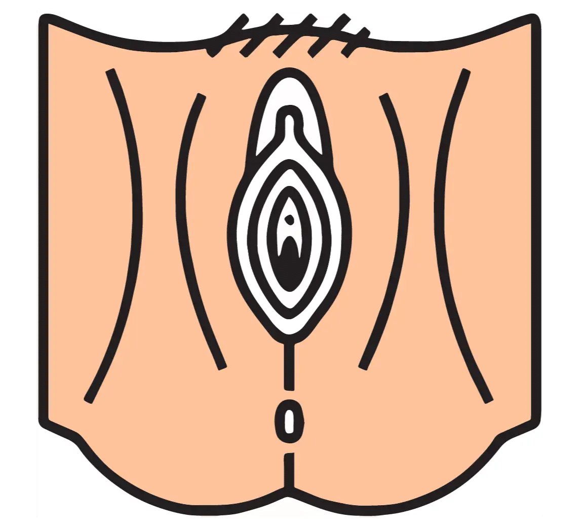 Perineoplasty (Perineal Repair Aesthetics)