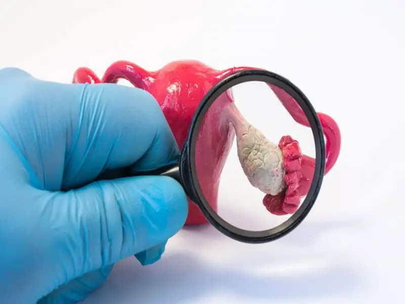 Ovarian Cyst Treatment
